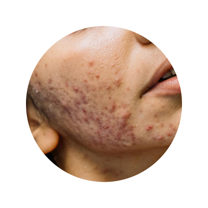 close up of acne on cheek