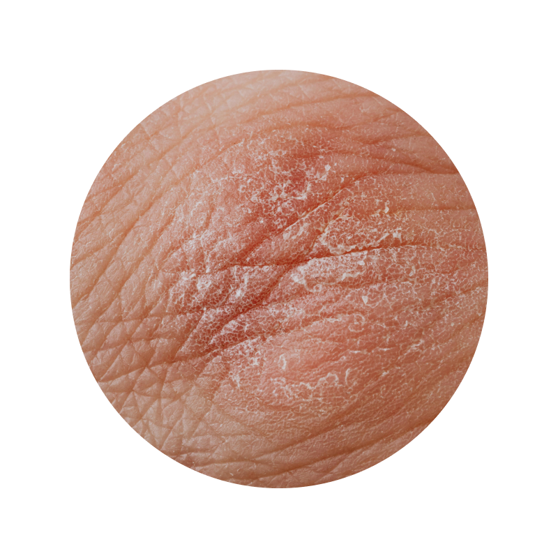 close up of dry and cracking skin