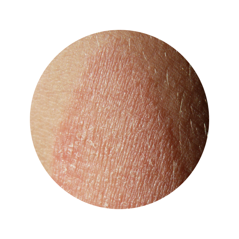 close up of red irritated skin